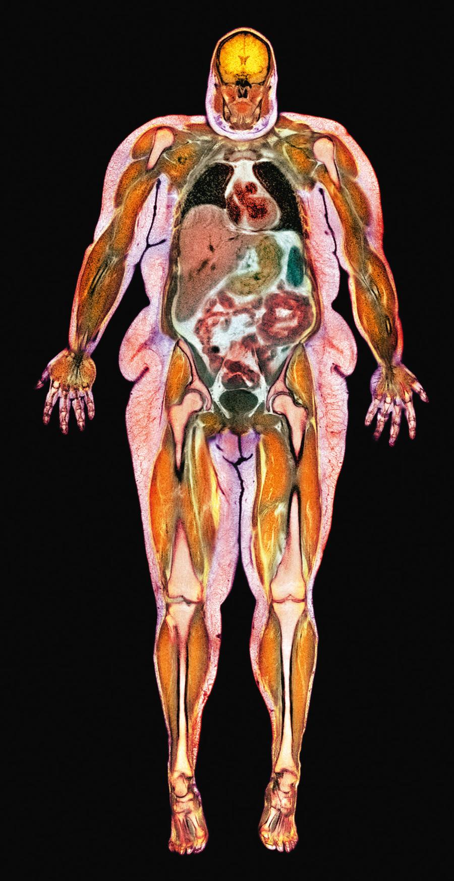 Rezonans magnetyczny ­otyłej kobiety. Widoczne nadmierne pokłady tkanki tłuszczowej (różowy).