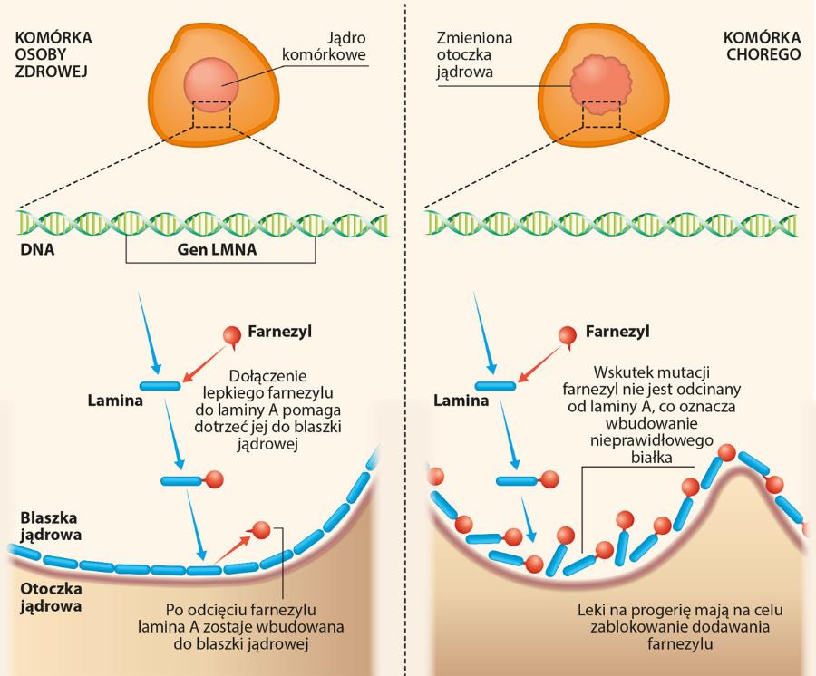 Za progerię odpowiada mutacja genu LMNA, który koduje ­białko zwane ­laminą A.