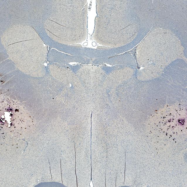 Alzheimer: odkryto kolejne źródło