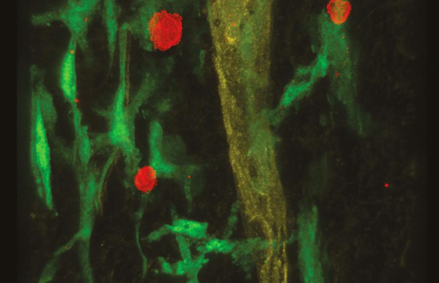 Wybarwiona tkanka uwidacznia limfocyty T (czerwone) i makrofagi (zielone), jak również naczynie limfatyczne (żółte) w oponach mózgowych.
