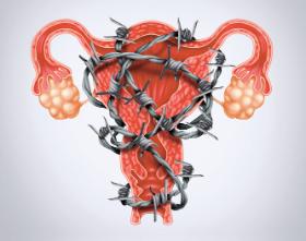 Według szacunków endometrioza dotyczy ok. 15 proc. kobiet w wieku rozrodczym. Zwykle to młode, szczupłe i zdrowo wyglądające osoby.