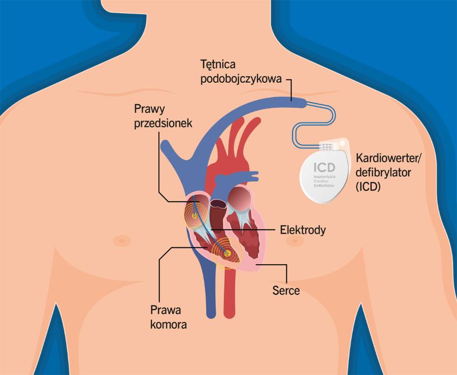 Schemat położenia kardiowertera i elektrod.