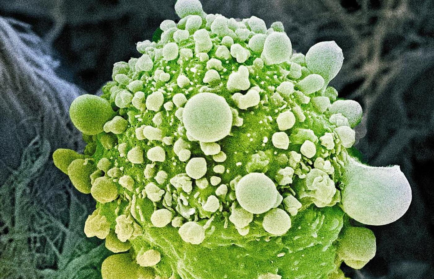 Mikroskopowy obraz komórki raka trzustki.