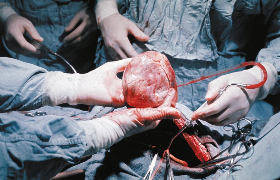 Narządy pobierane od ludzi: Przeżywalność pacjentów wzrosła od czasu tej transplantacji serca w roku 1968, jednak zwiększyły się niedobory narządów.
