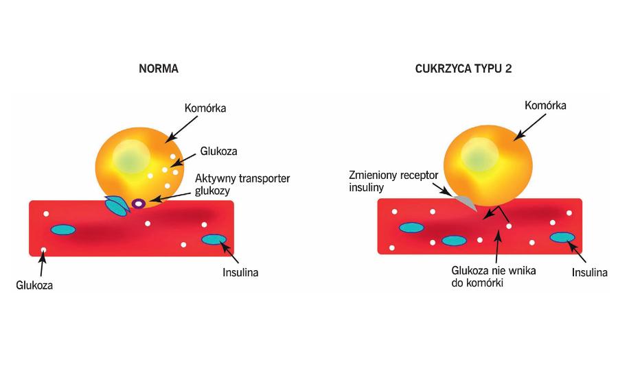 Jedną z przyczyn cukrzycy typu 2 jest insulinooporność, kiedy zaburzenia występują na poziomie receptora insuliny – insulina się z nim nie łączy lub sygnał nie jest dalej przekazywany.