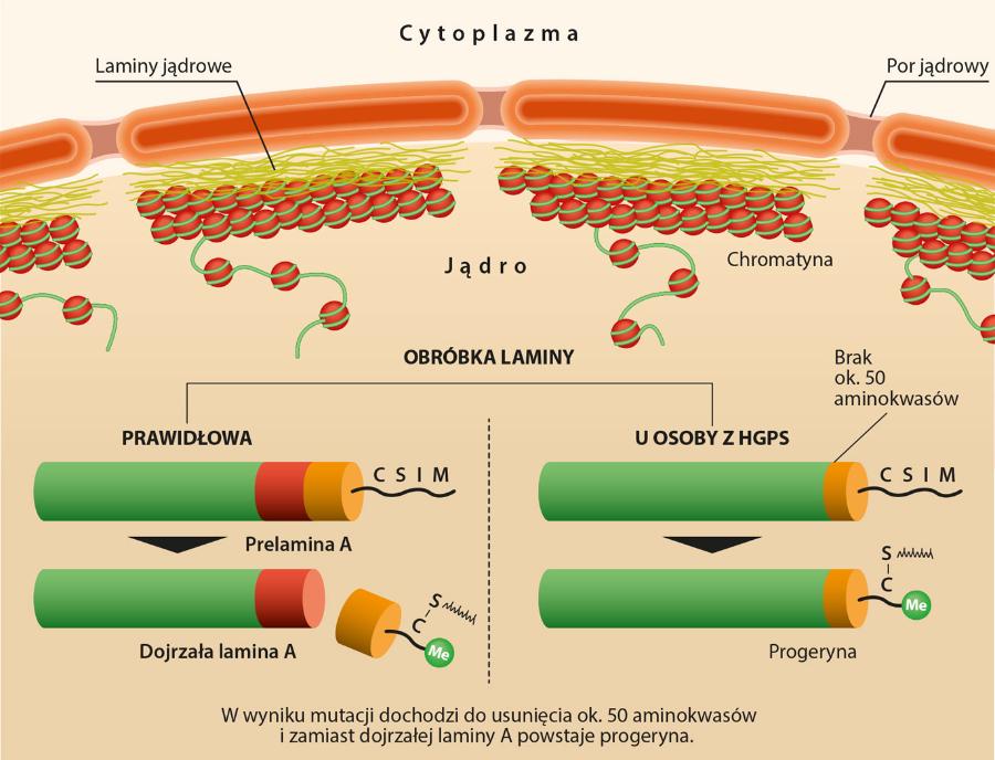 Obróbka ­laminy. Po lewej prawidłowa, po prawej u osoby z HGPS. W wyniku mutacji białko traci ok. 50 ­aminokwasów i zamiast dojrzałej ­laminy A powstaje progeryna.