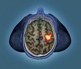 Obraz mózgu zdrowego pacjenta, pokazujący aktywność kory ruchowej przy poruszaniu lewą ręką w trakcie badania fMRI.