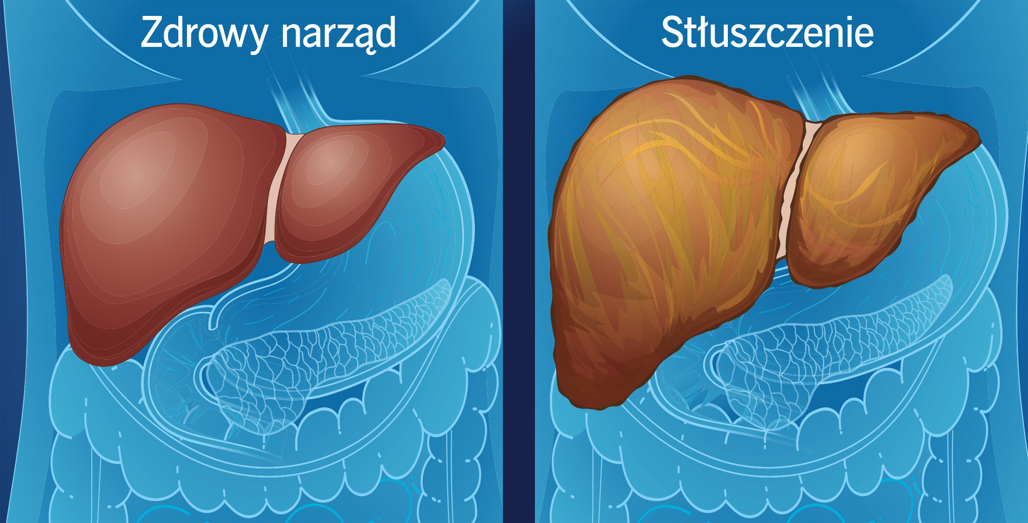 Ratunek dla chorej wątroby