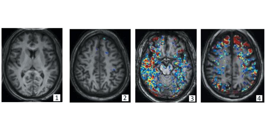 Starzejąca się barykada: Badania obrazowe mózgu, uwidaczniające cząsteczki znaczników we krwi, wykazują rosnące nieszczelności bariery krew-mózg w miarę starzenia się człowieka. Obraz mózgu 30-latka jest czysty (1). W wieku 42 lat niebieskie punkty wskazują na niewielkie przecieki (2). W wieku 65 lat żółte i czerwone punkty ujawniają większe nieszczelności (3). W wieku 76 lat proces ten się nasila (4).