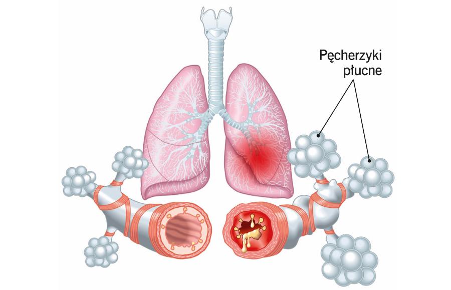 Płuco zdrowe (po lewej) i u astmatyka (po prawej). Wskutek choroby w świetle oskrzeli pojawia się śluz, a pęcherzyki płucne ulegają rozdęciu.