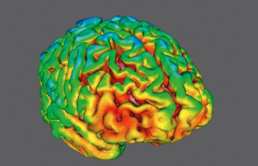 Skany mózgu osoby chorej na schizofrenię (po lewej) i zdrowej. Żółto-czerwone zabarwienie w obrazie PET (pozytonowej tomografii emisyjnej) wskazuje na wyższy poziom białka SV2A (obecne w pęcherzykach synaptycznych kontrolującego wydzielanie neuroprzekaźników).