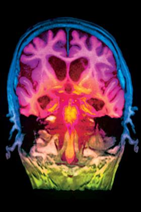 Sztucznie kolorowany obraz przekroju mózgu z objawami choroby Alzheimera uzyskany w rezonansie magnetycznym