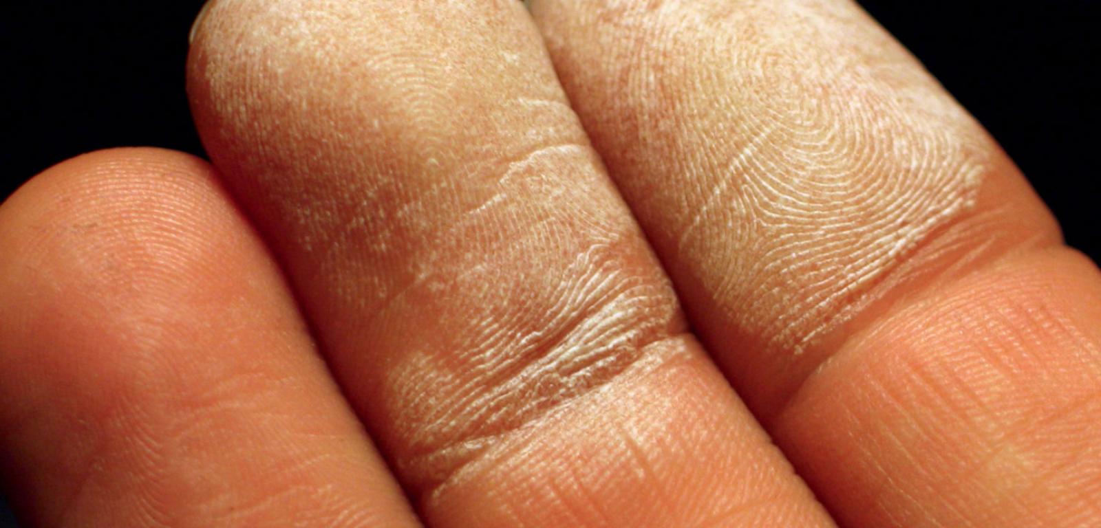 Stężony nadtlenek wodoru jest substancją żrącą. W kontakcie ze skórą ­powoduje powstawanie białych martwiczych plam.