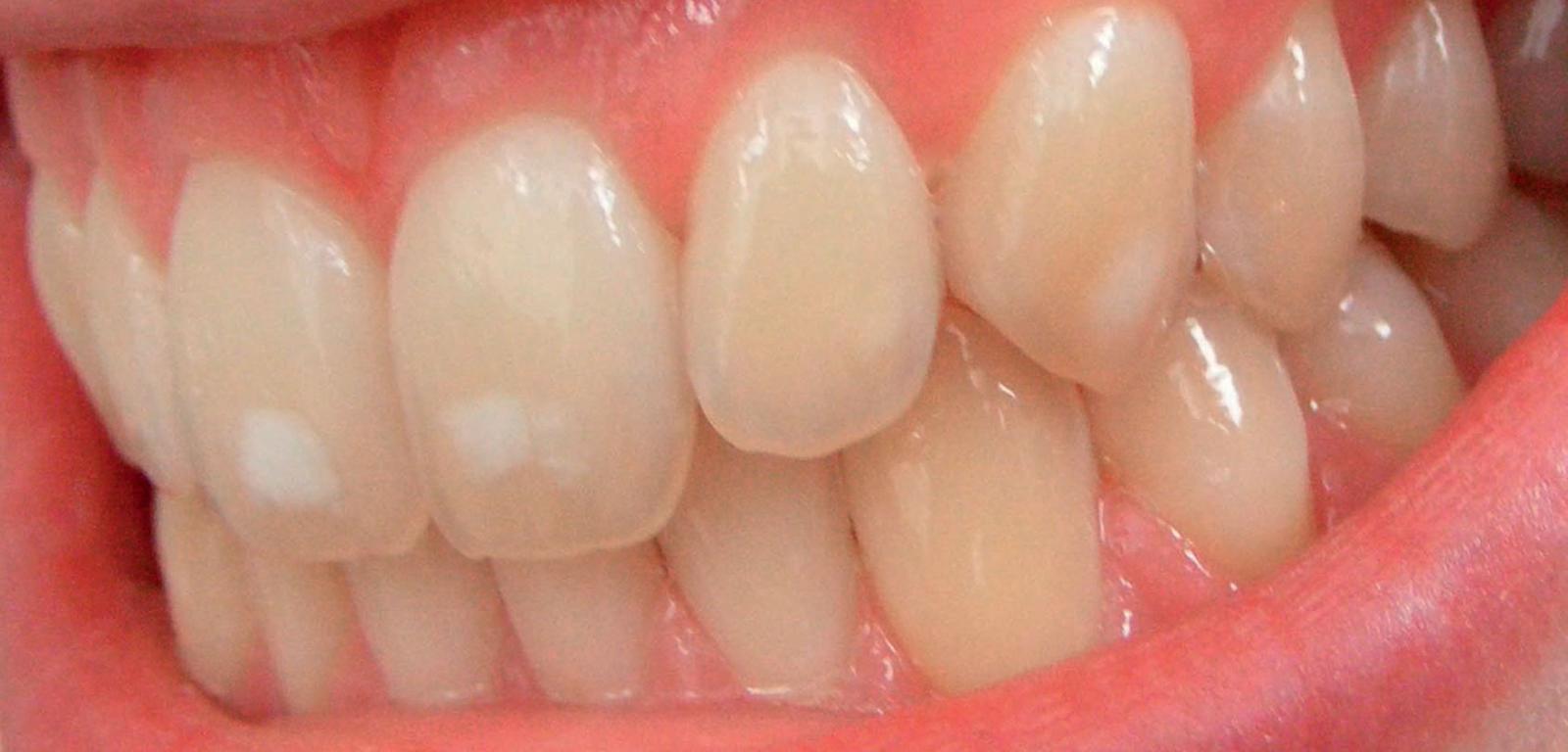 Fluoroza zębów. Plamy mogą być białe, żółte lub brązowe.