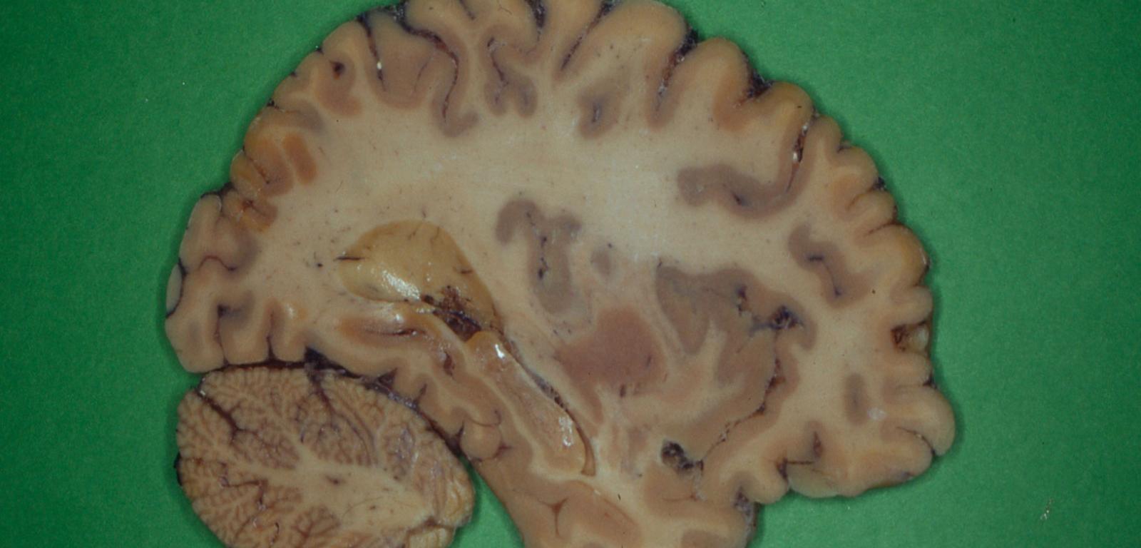 Skrawek ludzkiego mózgu do obserwacji mikroskopowej.