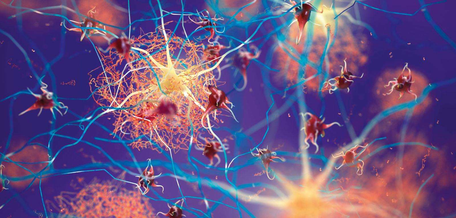 Złogi beta-amyloidu (pomarańczowe) pomiędzy neuronami. Działają one toksycznie na komórki nerwowe.