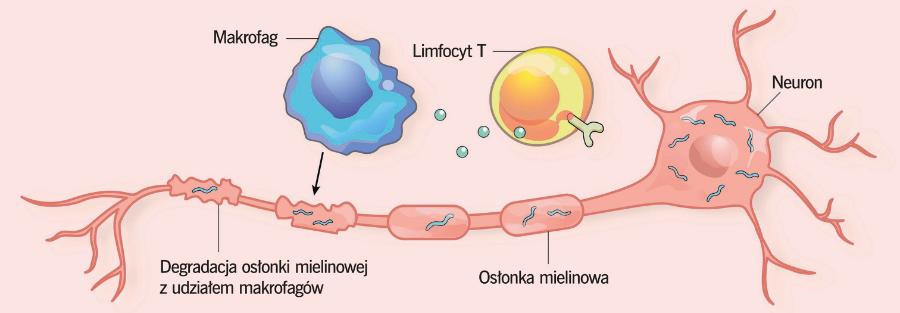 Stwardnienie rozsiane jest wynikiem uszkodzenia neuronalnych ­osłonek ­mielinowych. W proces ten zaangażowane są komórki układu odpornościowego.