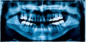 Co dwudziesty Polak nigdy nie czyści zębów.