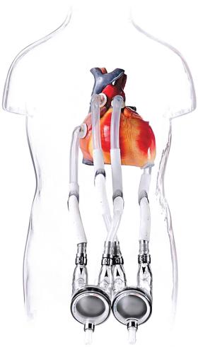 Berlińskie sztuczne serce –  wynalazek naukowców z Freie Universitat Berlin.