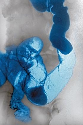 Rentgenowski obraz systemu trawiennego zaatakowanego przez raka