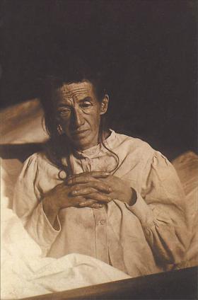 Auguste Deter w 1902 r. Pacjentka Aloisa Alzheimera. Pierwszy przypadek zdiagnozowanej choroby Alzheimera.
