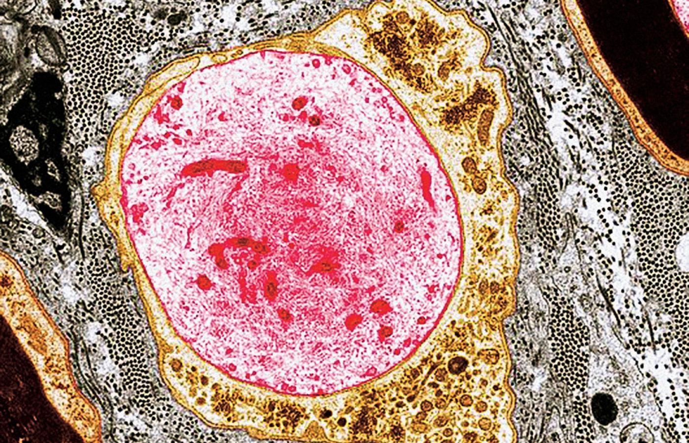 Obraz zniszczenia, czyli komórka nerwowa pozbawiona osłonki mielinowej na zdjęciu wykonanym za pomocą transmisyjnego mikroskopu elektronowego.
