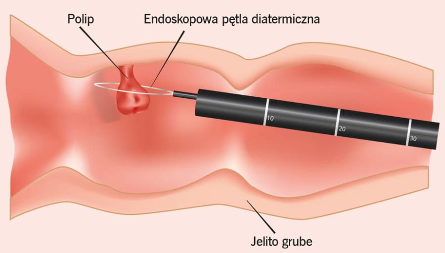 Usuwanie ­polipów ­jelita grubego. Są one źródłem krwawienia.