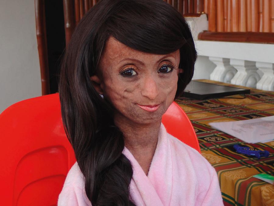 Ana Rochelle Pondare. Średnia ­długość życia dzieci z progerią wynosi 13 lat, ale dr Pierre R. Clero przedłużył życie Pondare, projektując dla niej specjalną dietę i kremy do pielęgnacji ­skóry. Dziewczyna zmarła w 2016 r. w wieku 19 lat.