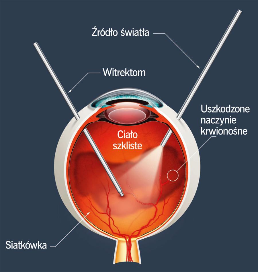 Witrektomia to zabieg operacyjny, w czasie którego usuwa się np. męty ciała szklistego. Innym sposobem na ich pozbycie się jest laserowa witreoliza (zabieg nieinwazyjny).