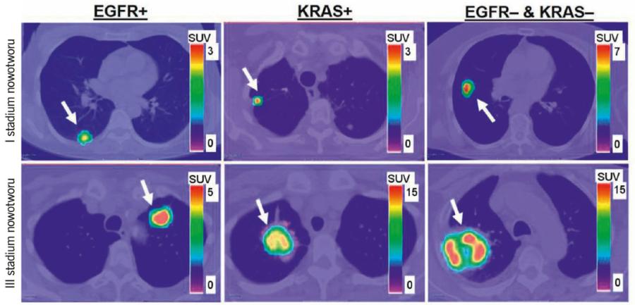 Nowotwory uwidocznione w obrazie PET. Strzałki pokazują lokalizacje guzów płuc z mutacjami EGFR+ i KRAS+ oraz bez tych mutacji (EGFR- i KRAS-).