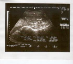 W Europie badanie płodu w kierunku wykrycia nieprawidłowej liczby chromosomów  wykonuje się głównie przy pomocy usg i testu PAPP-A.