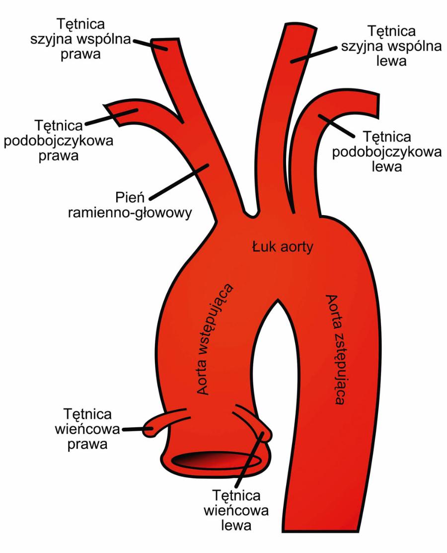 Kontrapulsacja wewnątrzaortalna. Pulsujący balonik z helem umieszcza się tuż poniżej odejścia tętnicy podobojczykowej lewej.