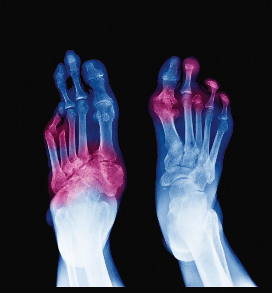 Martwica tkanek w zespole stopy cukrzycowej. Zdjęcie rentgenowskie. Różowe obszary – zajęte stawy.