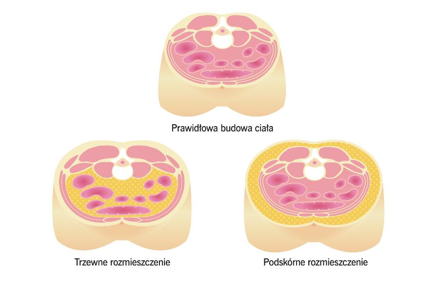 Rozmieszczenie tkanki tłuszczowej (zaznaczona na żółto) mówi o rodzaju otyłości. Przy otyłości trzewnej tłuszcz otacza narządy wewnętrzne.