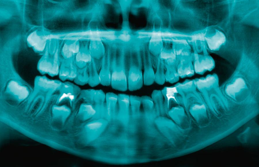 Pantomogram to zdjęcie panoramiczne zębów. Jest najczęściej zlecanym w stomatologii badaniem z użyciem promieni rentgenowskich.