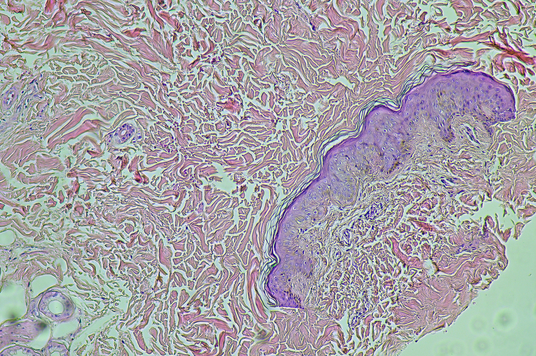 Zmodyfikowana terapia CAR-T daje nadzieję na skuteczniejsze leczenie guzów litych
