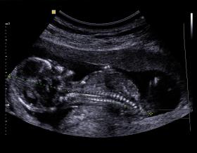 Zarodek ludzki. Obraz USG