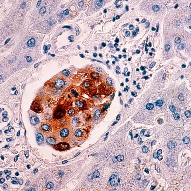 Nowotwory: jest nowa metoda na usprawnienie terapii celowanej