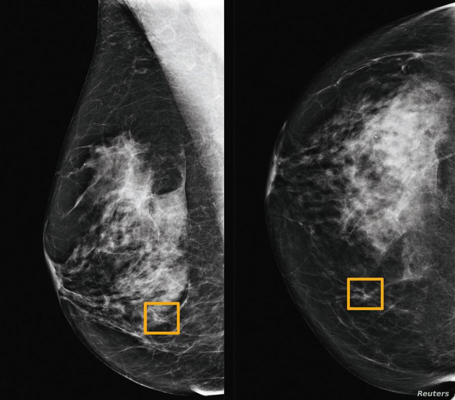 Sztuczna inteligencja poprawia dokładność badań mammograficznych (żółte pola wskazują wykrytego przez nią raka).