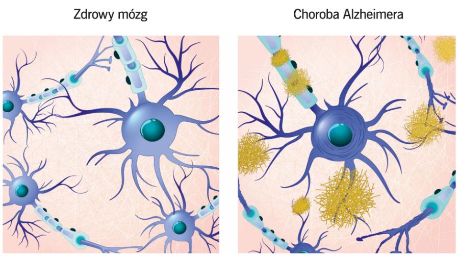 Blaszki beta-amyloidu odkładają się wokół neuronów.