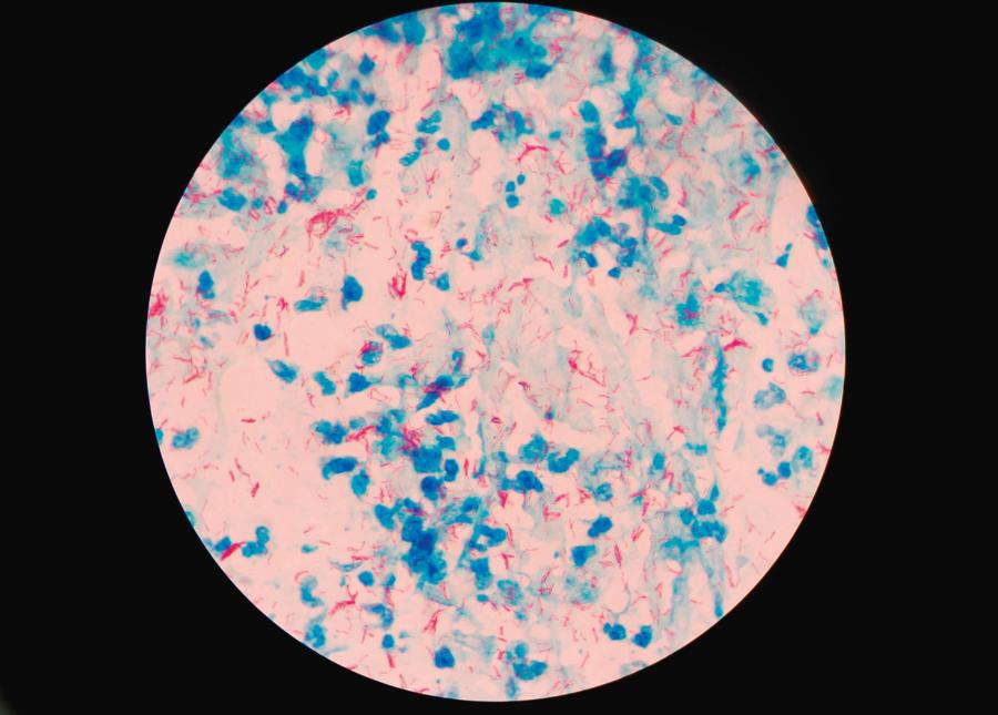 Mycobacterium tuberculosis (czerwony) pod mikroskopem.