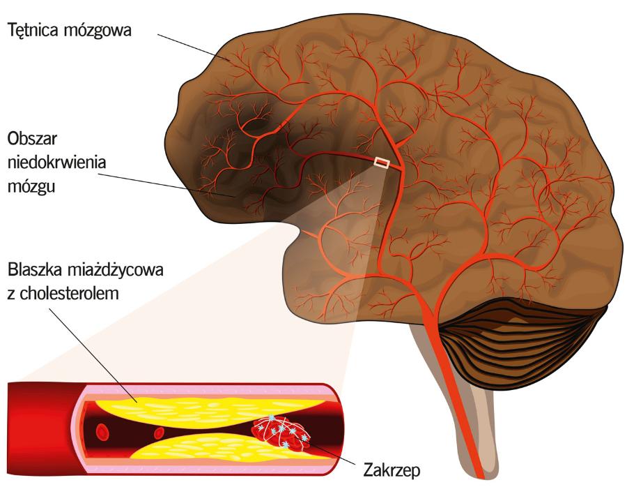 Niedokrwienny udar mózgu. Na skutek zakrzepu w tętnicy dochodzi do upośledzenia dopływu krwi do tkanki mózgowej.