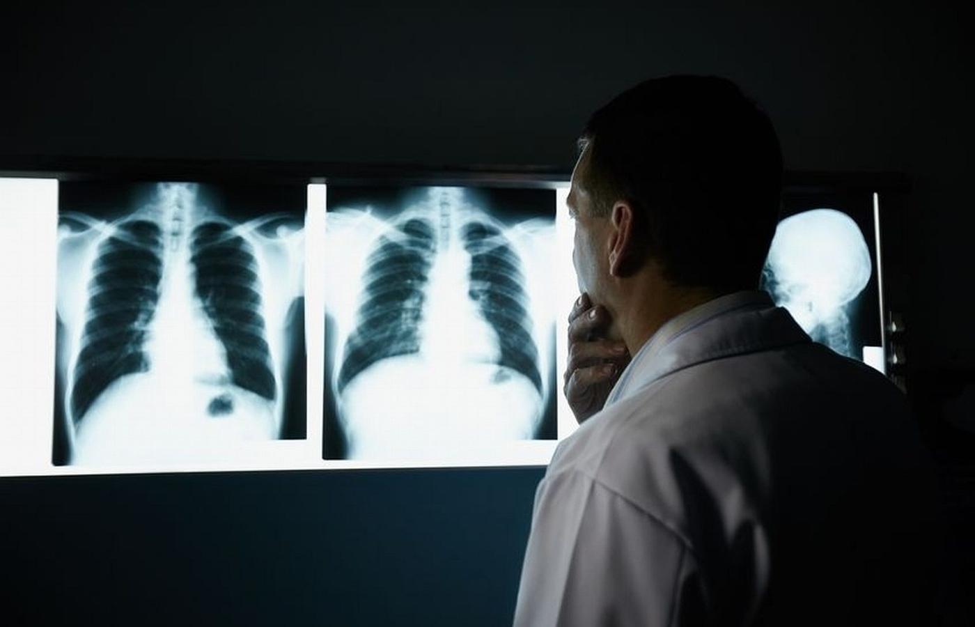 Rak płuc rozwija się początkowo bez objawów, które mogłyby zaniepokoić chorego.
