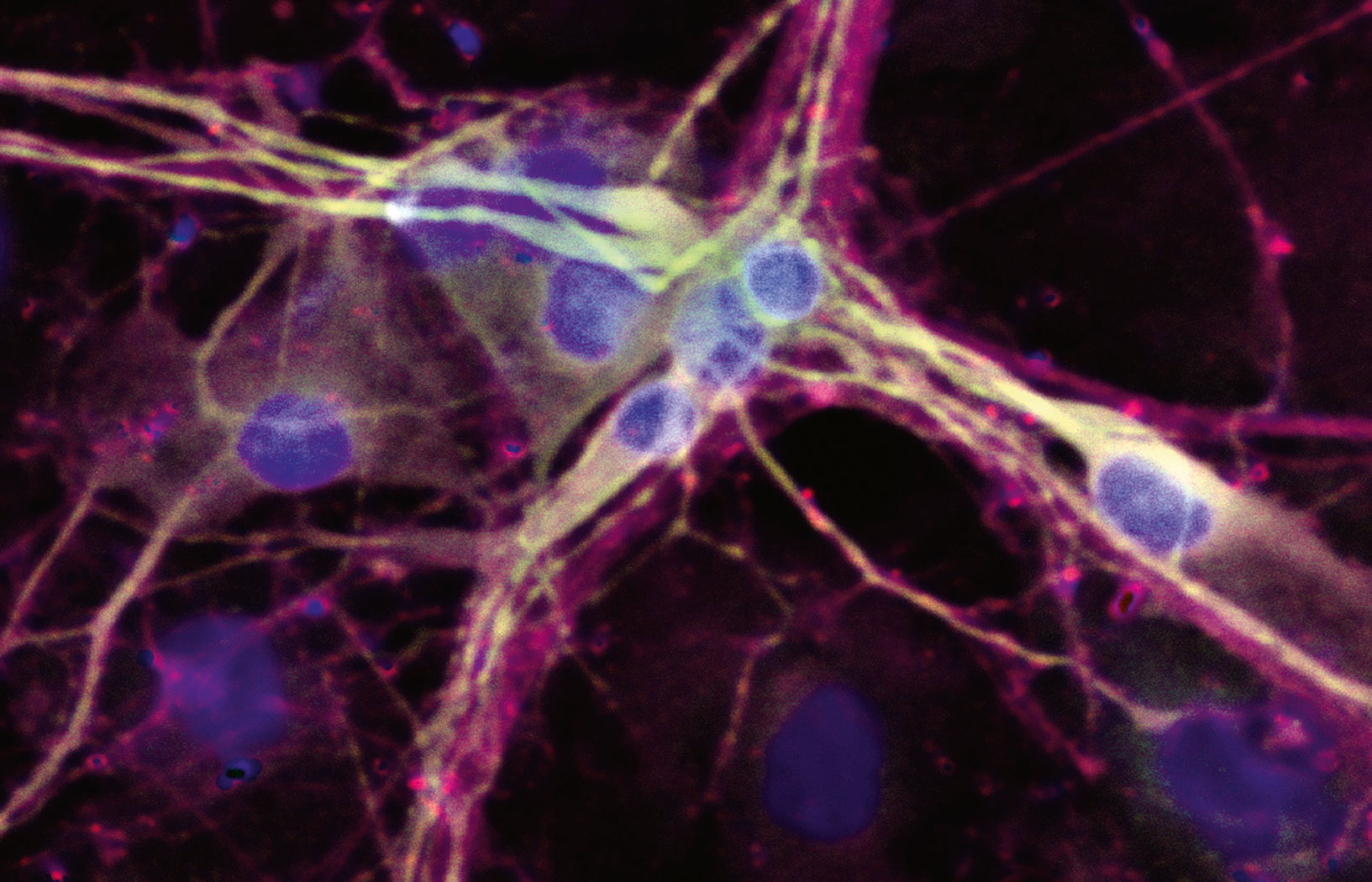 Nowotwór okrada neurony