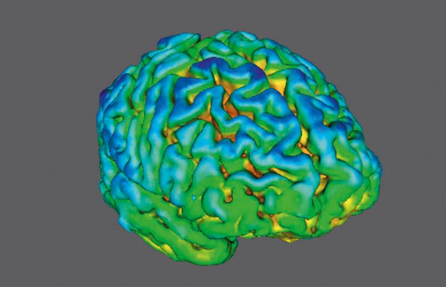 Skany mózgu osoby chorej na schizofrenię (po lewej) i zdrowej. Żółto-czerwone zabarwienie w obrazie PET (pozytonowej tomografii emisyjnej) wskazuje na wyższy poziom białka SV2A (obecne w pęcherzykach synaptycznych kontrolującego wydzielanie neuroprzekaźników).