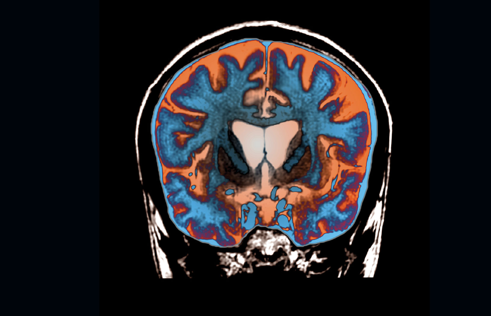 Nadzieje dla chorych na chorobę Huntingtona