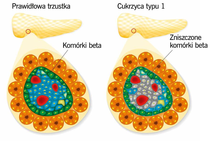 Insulinę produkują komórki beta wysp trzustkowych. Ich zniszczenie prowadzi do cukrzycy typu 1.