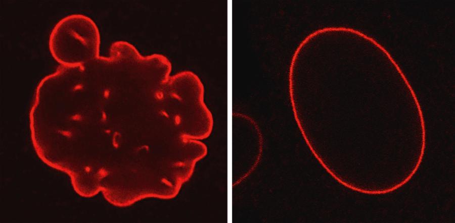 Jądra komórkowe fibroblastów (komórek skóry właściwej). Po lewej – chorego na progerię, po prawej – osoby zdrowej.