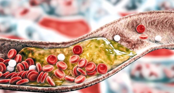 Wszyscy skoncentrowani są na cholesterolu, a niewiele osób wie o lipoproteinie (a), której wysoki poziom zwiększa ryzyko zawału serca aż trzykrotnie.