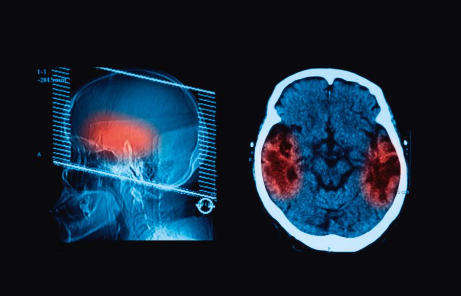 Obraz ­tomografii komputerowej mózgu uwidaczniający udar. To badanie najlepiej wskazuje miejsce i rozmiar zniszczenia tkanki.